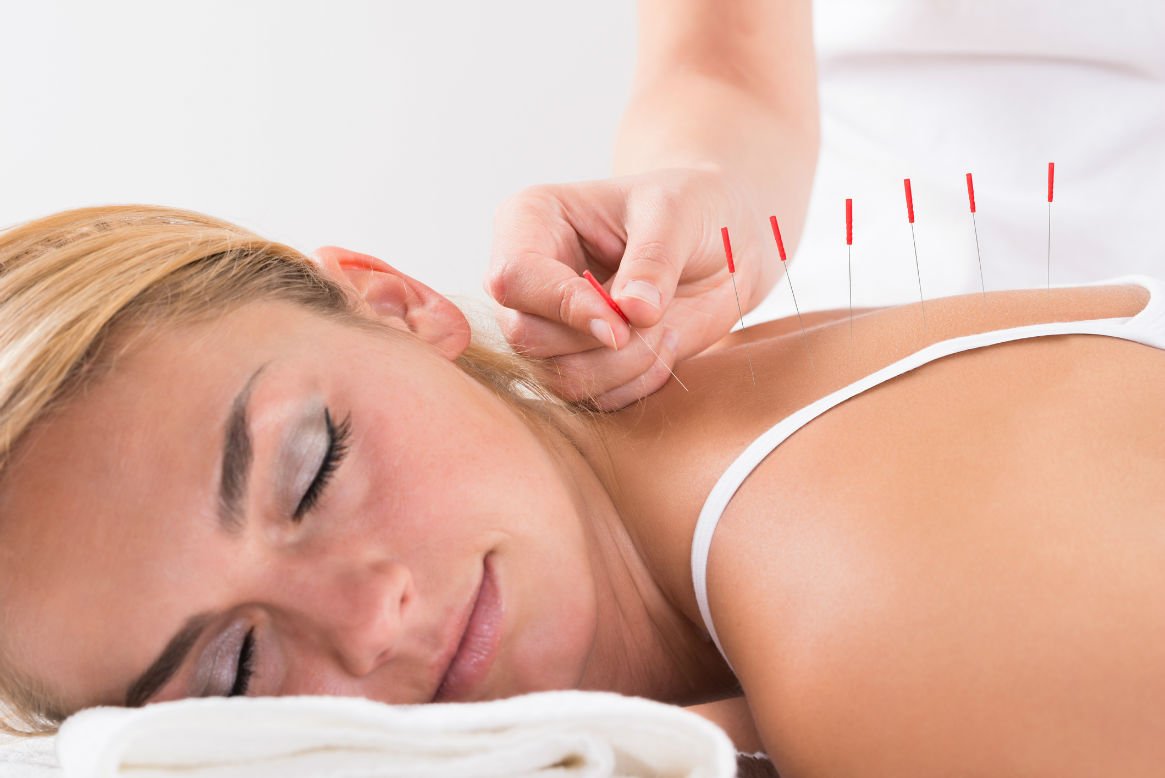 Progressive Medical Fitness acupuncture-therapy Acupuncture  