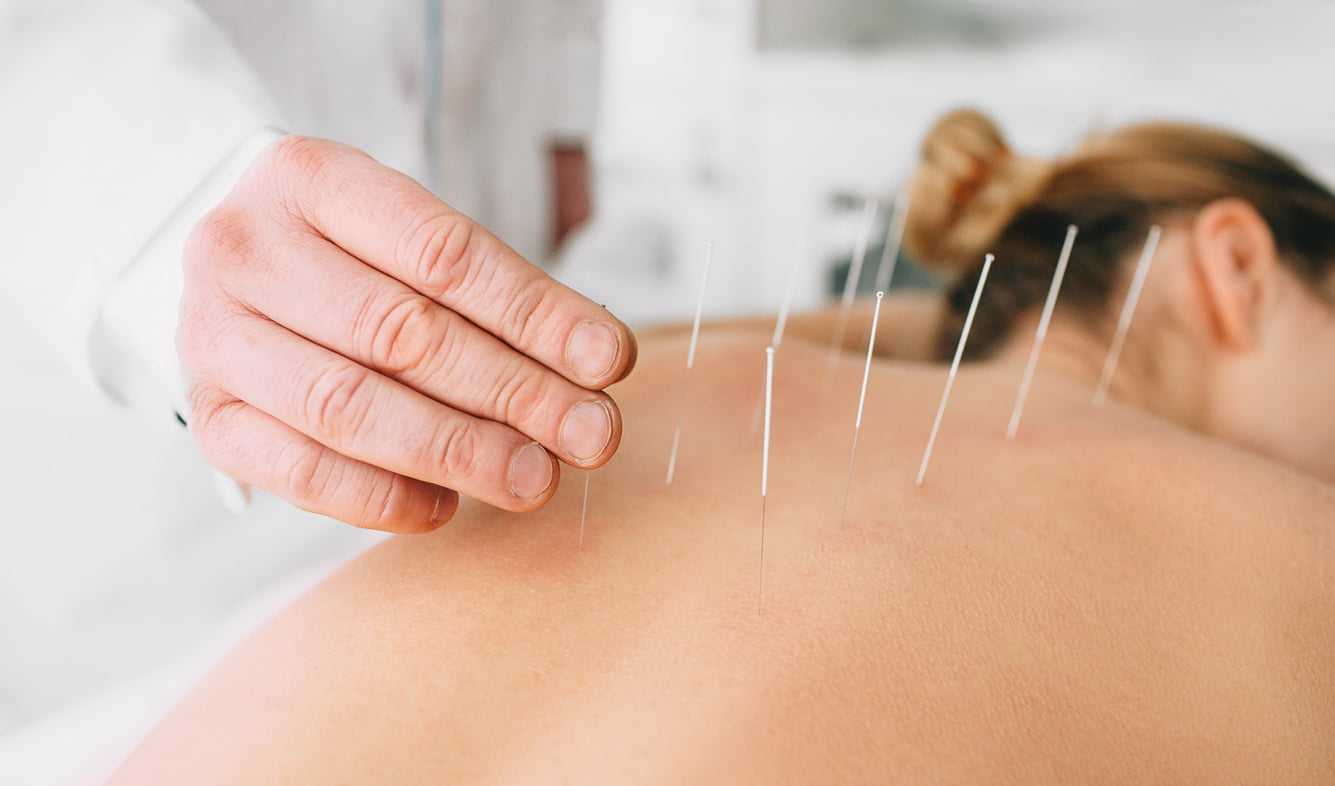 Progressive Medical Fitness acupuncture-treatment Acupuncture  